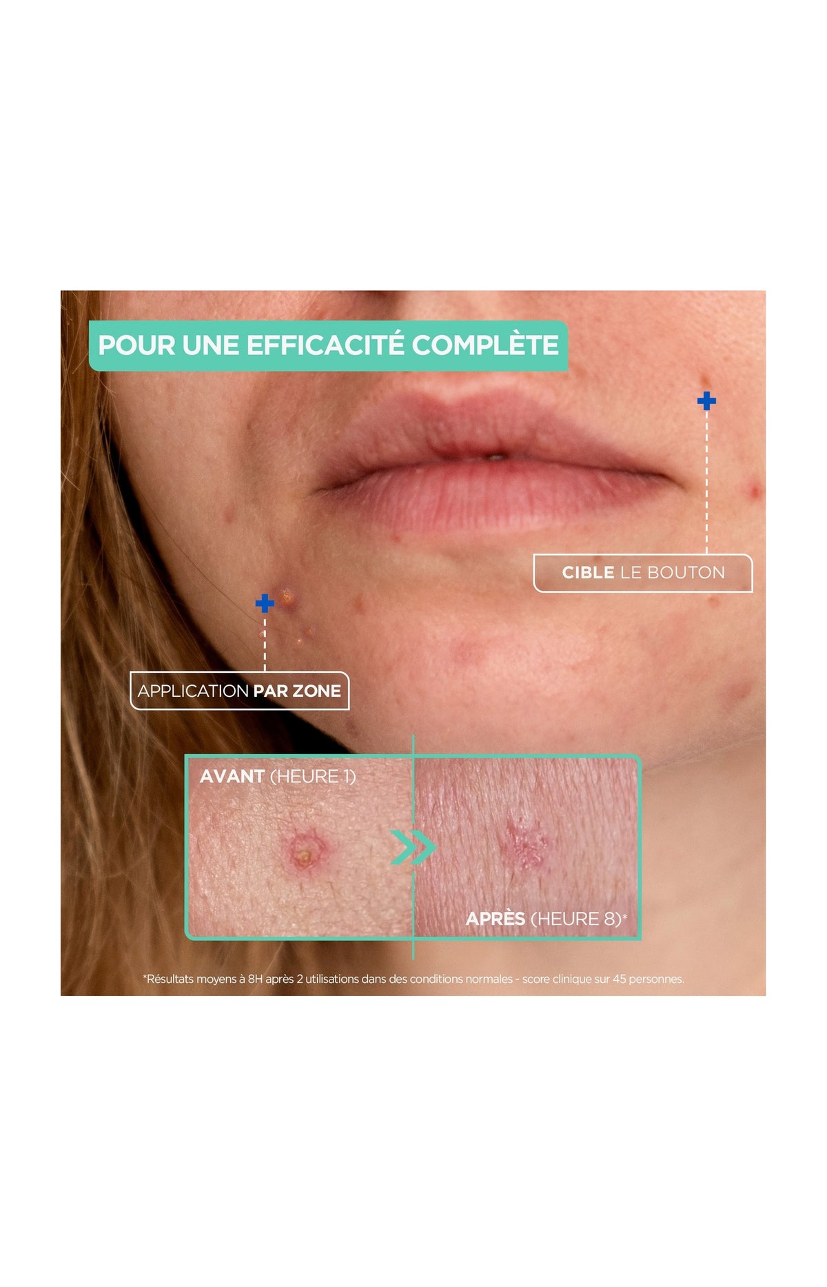 Pâte anti-boutons - Argile, acide salicylique & niacinamide - Visage